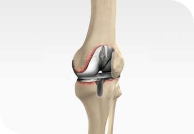 Revision Total Knee Replacement